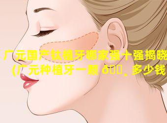 广元国产钛植牙哪家强十强揭晓(广元种植牙一颗 🕸 多少钱)